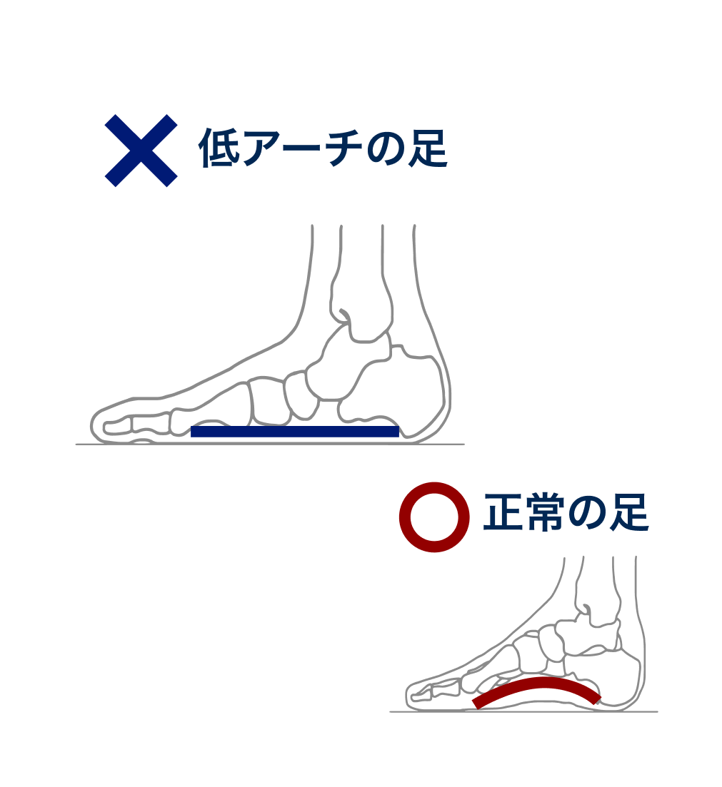 低アーチの足と正常の足の比較イメージ